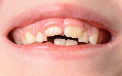 ¿Que es la atricción lingual?