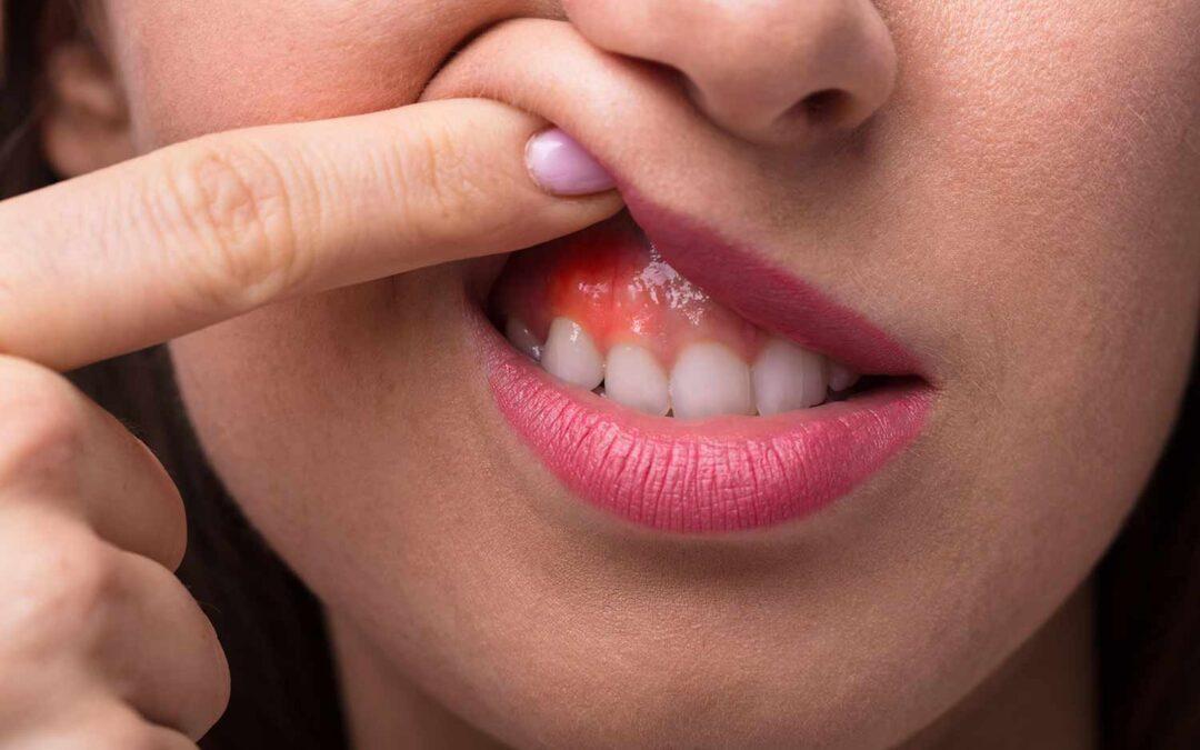 Tratamiento de encías sangrantes en Durango