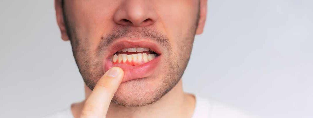 Gingivitis: por qué sucede y cómo tratarla en Clínica Dental Oiz Durango