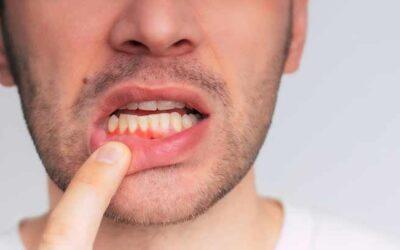 Gingivitis: por qué sucede y cómo tratarla en Clínica Dental Oiz Durango
