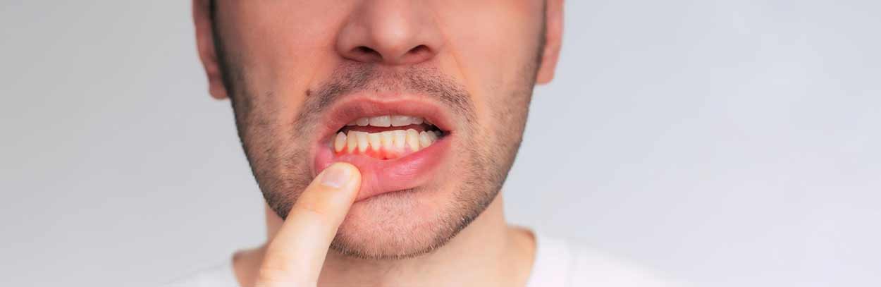 tratar-gingivitis-durango tratar gingivitis durango