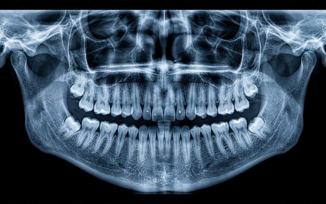 Quiste dental en Durango: diagnóstico y tratamiento de lesiones quísticas odontogénicas