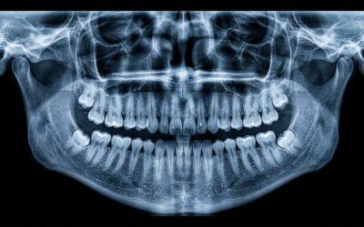 Quiste dental en Durango: diagnóstico y tratamiento de lesiones quísticas odontogénicas